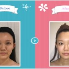 本気の小顔モニター2